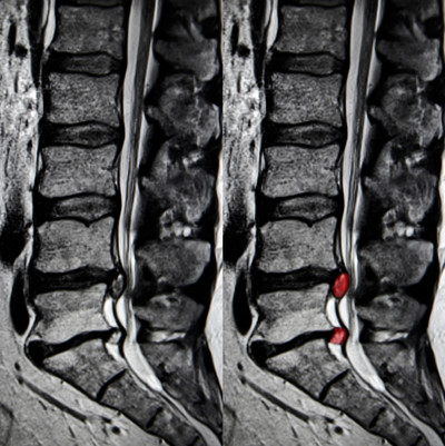 Sciatica